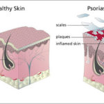 Psoriasis, alteración de la piel.