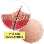 Queratosis Pilaris – Tratamiento para la Piel de Gallina