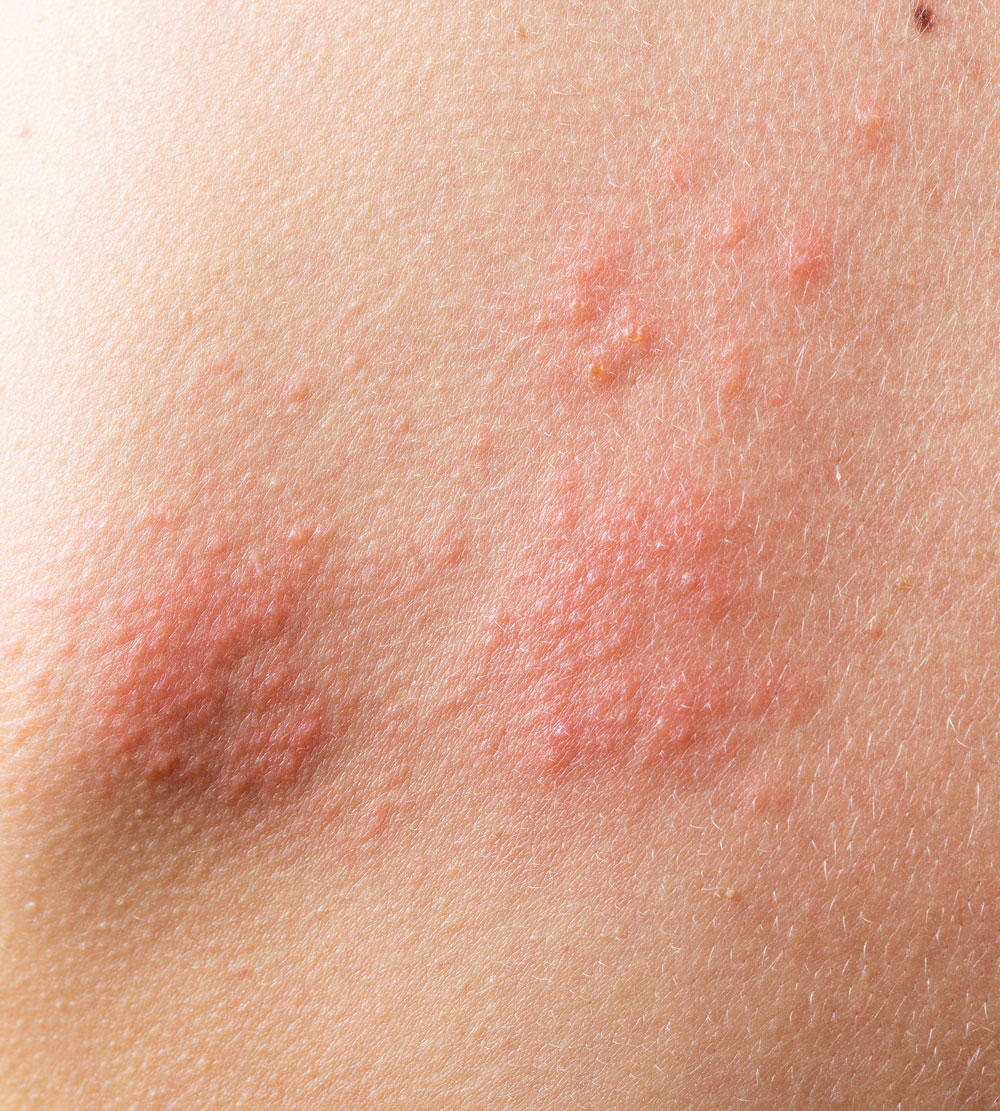 acné vulgar y dermatitis seborreica